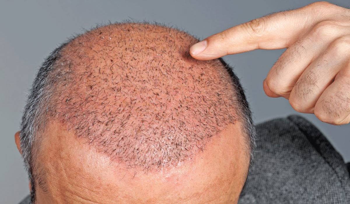 عملية زراعة الشعر , زراعه الشعر عمليه تجميليه تحسن مظهرك