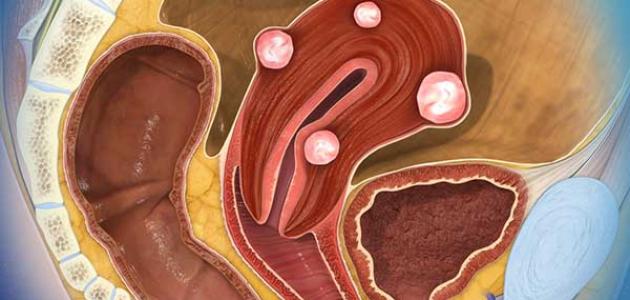 اورام الرحم الليفية - اكتشاف اورام الرحم