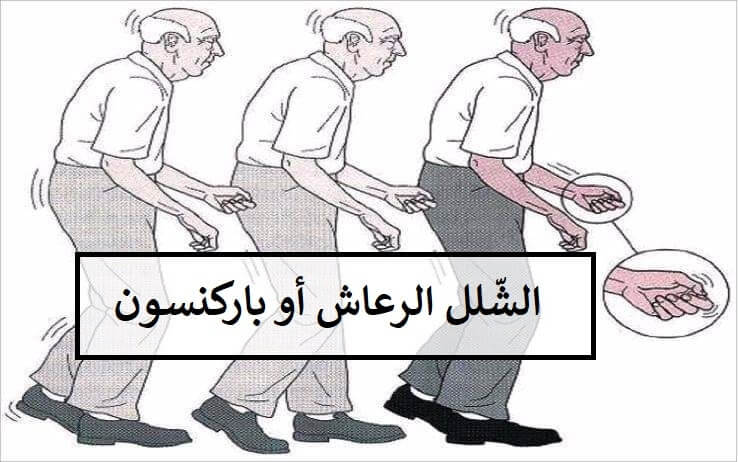 نبذه عامة واعراض مرض الباركنسون , مرض باركنسون