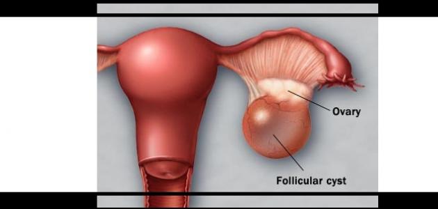 اعراض تكيس المبايض - تعرف على الاعرراض الشائعة لتكيس المبايض 1618 3