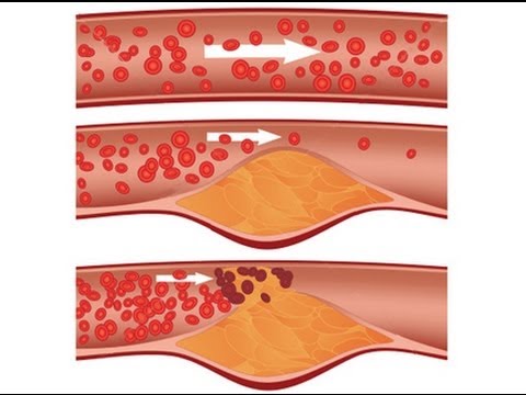 علاج الكولسترول - العلاج الاشهر للقضاء علي الكولسترول 5349 1