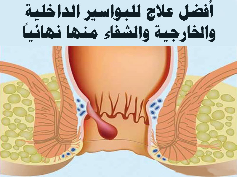 طريقه علاج البواسير بالاعشاب والزيوت الطبيعية , علاج البواسير