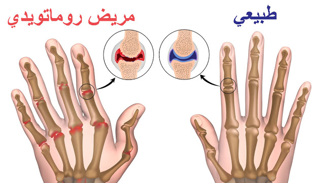 الصيدلية المنزلية - علاج التهاب المفاصل الروماتويدي بالاعشاب 11802 3