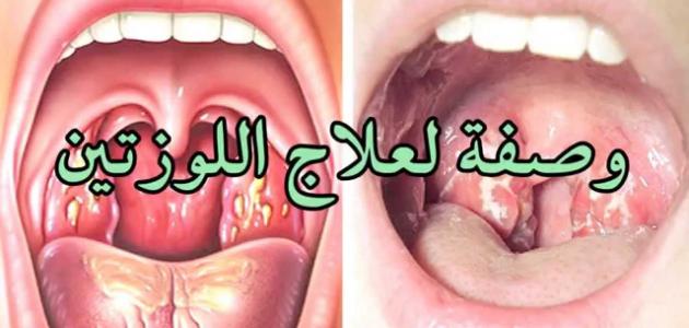 علاج التهاب اللوزتين , طريقه علاج التهاب اللوزتين