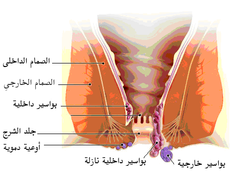 مرض البواسير - اعراض وعلاج مرض البواسير 2524 1