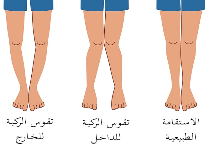 الحل السحري لتقوس الساقين - علاج تقوس الساقين 11696 3