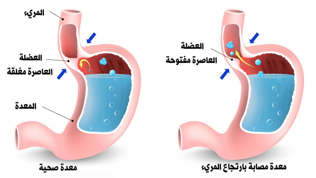 ارتجاع حموضة المعدة 12578 1