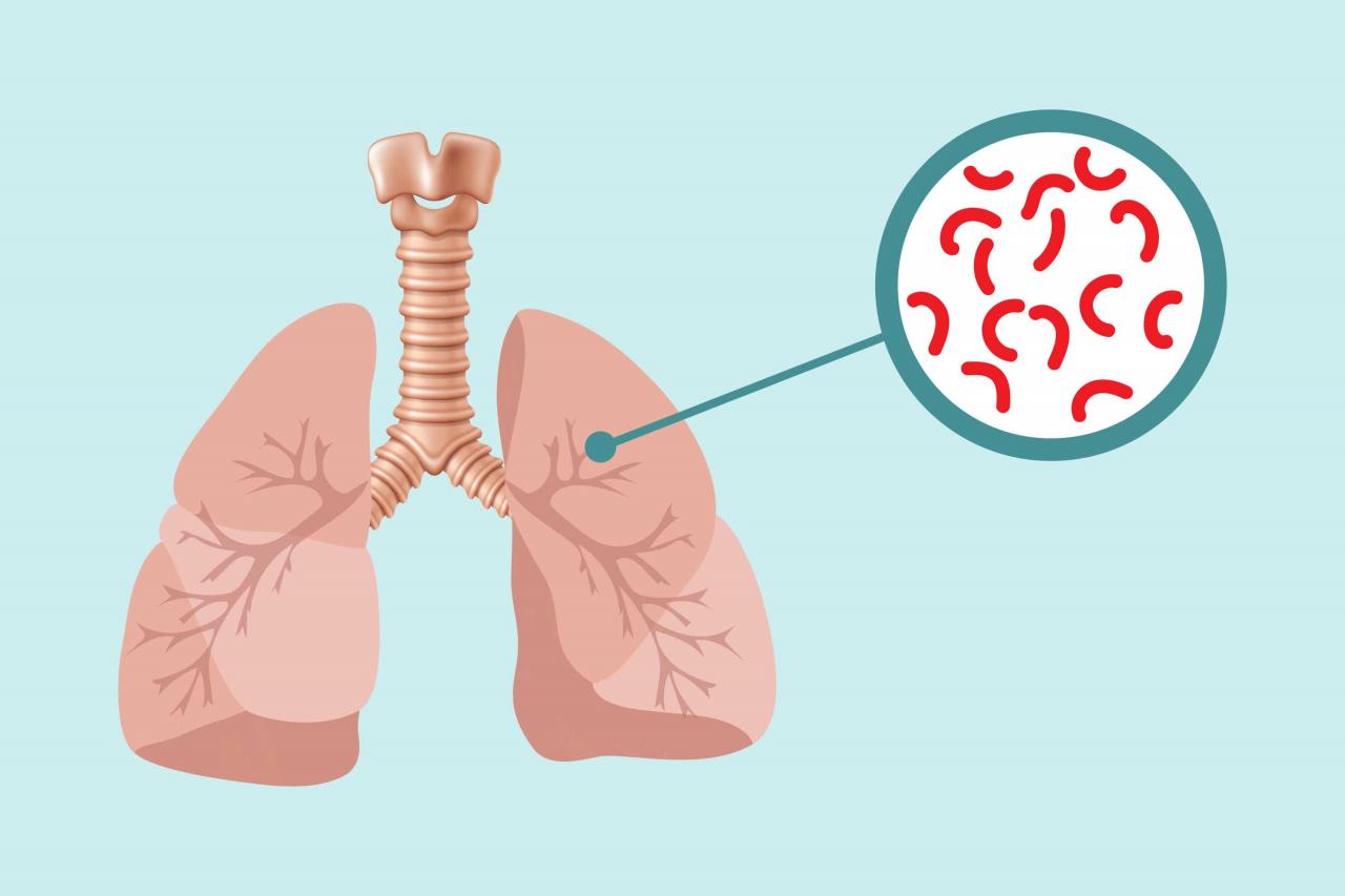 علاج مرض السل - كيف يتم العلاج لمرض السل والوقاية منه - 4035 12