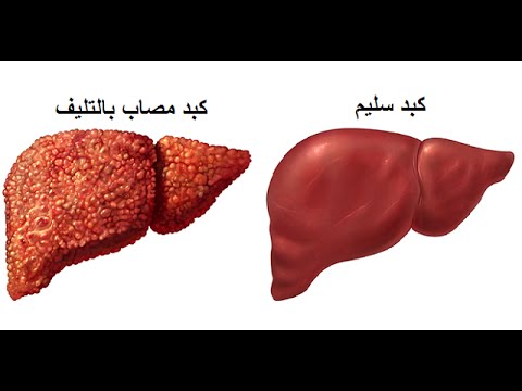 علاج تليف الكبد , اسباب تليف الكبد وطرق علاجه