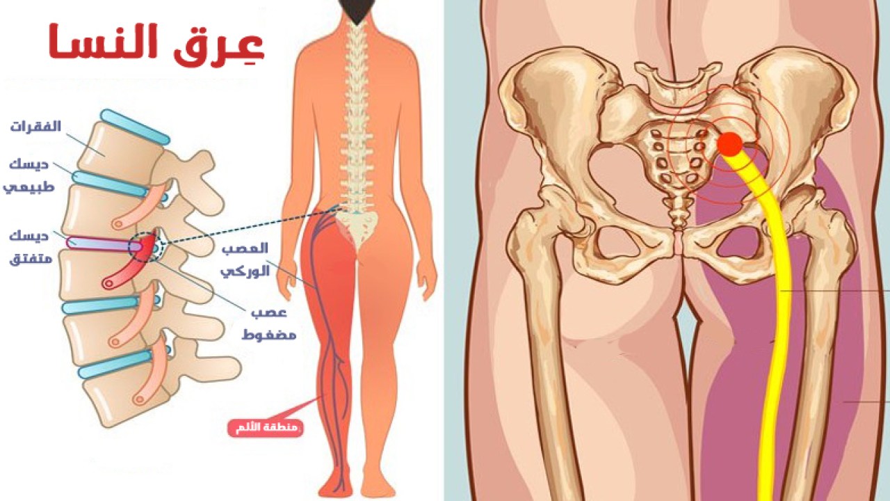 علاج التهاب عرق النسا - العلاج الطبيعي لتخفيف الام عرق النسا 12687 1