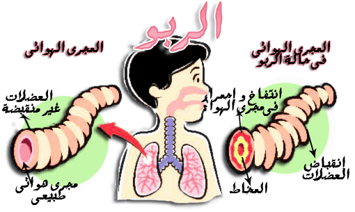 مرض الربو - ما هو مرض الربو واعراضه 6060 1