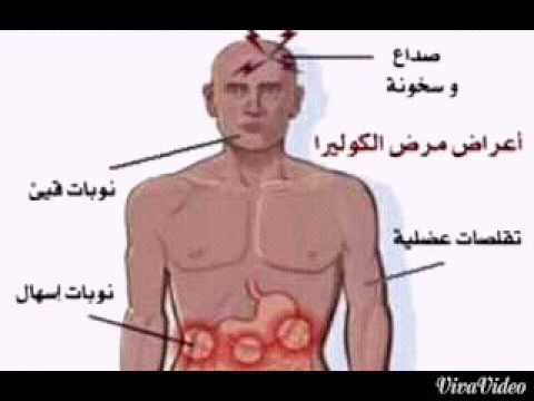 اعراض مرض الكوليرا , ما هي اعراض الاصابه بالكوليرا