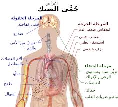 اعراض مرض الكوليرا - ما هي اعراض الاصابه بالكوليرا 5448 1