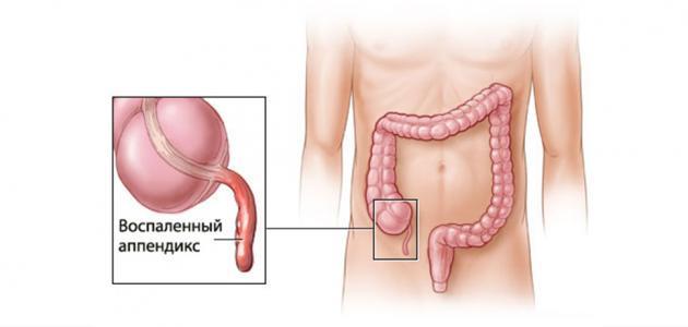 اعراض الزائدة الدودية , دلالات التهاب الزايده