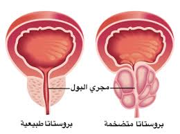 علاج تضخم البروستاتا - كيف اتخلص من تضخم البروستاتا 343 3