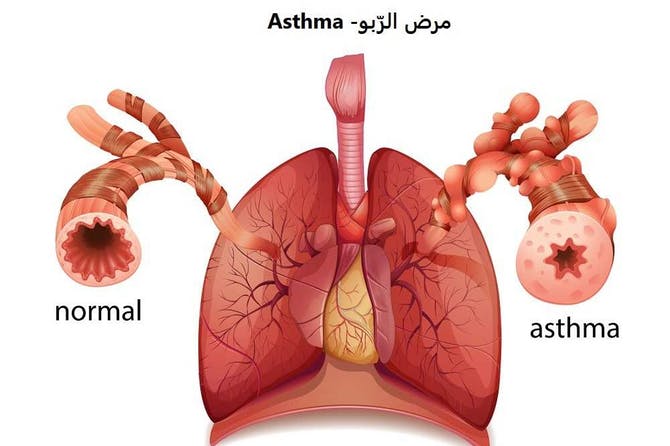 مرض الربو - ما هو مرض الربو واعراضه 6060