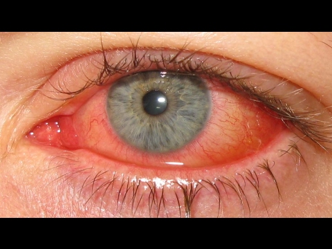 العين الحمراء , سبب احمرار العين - كلام نسوان